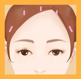 내시경 이마거상(Endoscopic forehead lift)에 대하여 성형외과 전문의가 알려드립니다. 관련 이미지 3