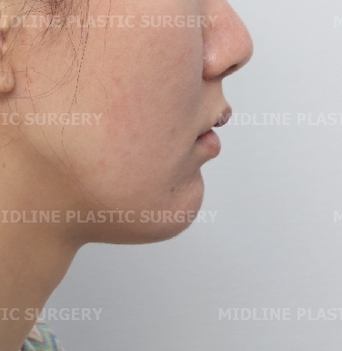 A Plastic Surgeon Explains the Changes in the Front and Side Views After Reduction Genioplasty and Advancement Genioplasty. (Feat. Rhinoplasty) image 1
