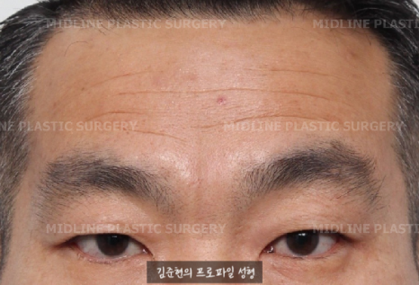 쌍꺼풀을 하려는데 이마주름이 심각해요....어떡하죠? 상남자의 자연스런 쌍꺼풀 만들기(Feat. 내시경 이마거상) 관련 이미지 3