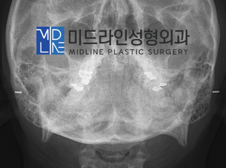 A Plastic Surgery Specialist Explains Why Chin Liposuction Is Sometimes Essential Because Jaw Reduction Surgery Alone Has Limited Effect image 4
