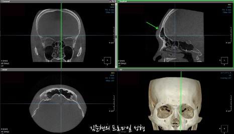 눈썹뼈절삭, 어떨 때 어떻게 하는 수술일까요? 꼭 이마거상과 함께 해야만 하는 수술인가요? 미드라인성형외과에서 하는 눈썹뼈절삭 수술을 설명드립니다. (3D CT 있음) 관련 이미지 22