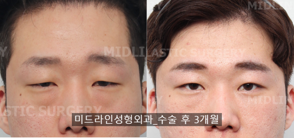<3편> 큰 눈 만들기 프로젝트. 이마거상으로 커진 눈!! 쌍꺼풀 수술로 더 크게 만들기. 관련 이미지 11