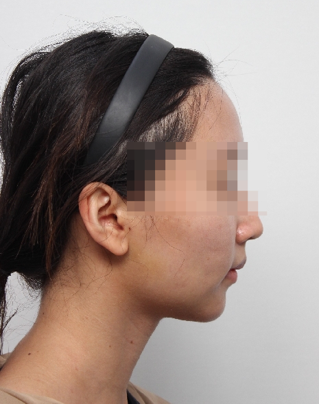 무턱 교정하면서 턱끝 비대칭(안면비대칭)까지 바로잡기! 관련 이미지 18