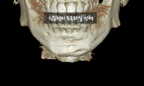 앞턱 보형물이 턱 옆으로 뚫고 나와요ㅠㅠ앞턱 보형물 제거 후 턱끝전진술을 한 케이스를 성형외과 전문의가 설명합니다. 관련 이미지 5