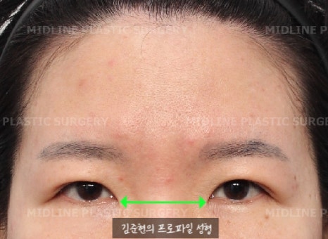 Because of the Mongolian fold, the eyes look cramped — epicanthoplasty can fix it. (Feat. Endoscopic forehead lift) image 3