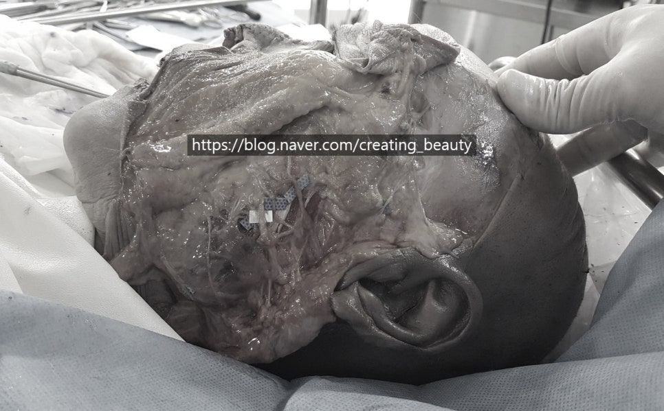 안면거상(Face lift, Rhytidectomy)에 대하여 성형외과 전문의가 알려드립니다. 관련 이미지 9