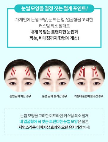 멀티 내시경이마거상술 vs 일반 이마거상술 차이점! 관련 이미지 8