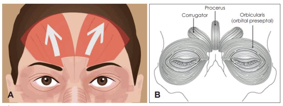 Headache, vomiting, pain, nausea after forehead lift... is it a side effect?! Here's my answer. image 3