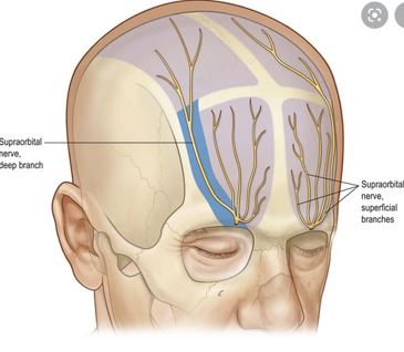 Headache, vomiting, pain, nausea after forehead lift... is it a side effect?! Here's my answer. image 6