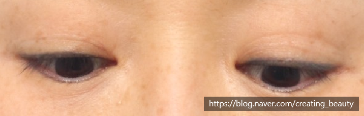 겹주름 있는 짝눈!! 짝눈교정 방법에 대하여 성형외과 전문의가 설명해 드립니다. (절개눈매교정 & 눈위 지방이식) 관련 이미지 6