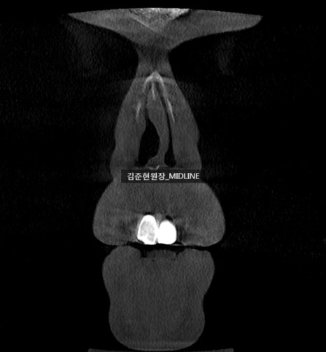 휜 코, 매부리 교정과 기능코-비중격만곡증까지 바로잡기 관련 이미지 13