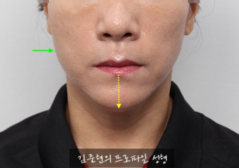 수술없이 간단하게 안면비대칭, 턱끝 비대칭(미드라인 맞추기) 해결하기!! 관련 이미지 9