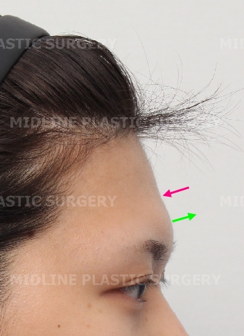 Forehead Lift for a Forehead with Prominent Brow Bones?? image 5
