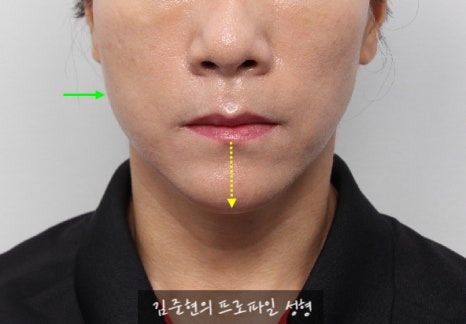 수술없이 간단하게 안면비대칭, 턱끝 비대칭(미드라인 맞추기) 해결하기!! 관련 이미지 13