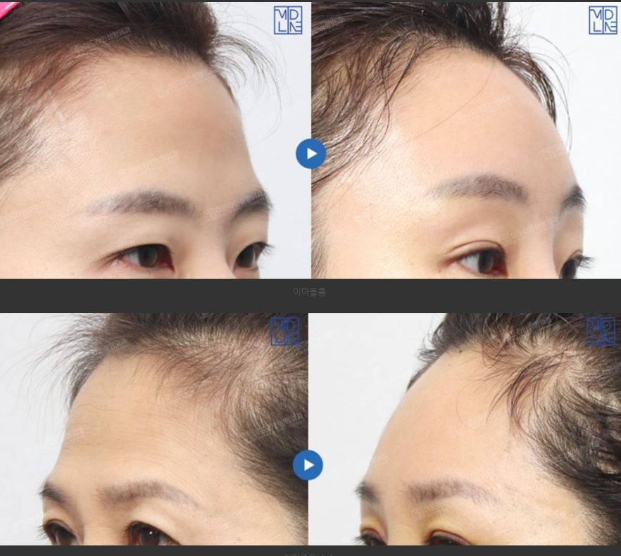 필러&middot;보형물 부작용, 골흡수 됐을 때 해결 방법은? 관련 이미지 5
