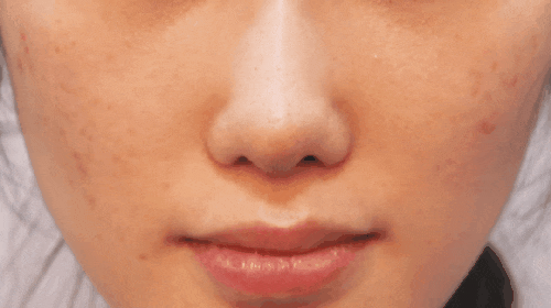 코막힘 원인, 비밸브재건술에 대하여 성형외과 전문의가 설명드립니다. 관련 이미지 10