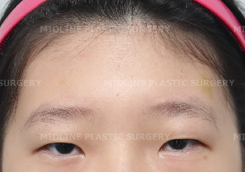 <1편> 쌍꺼풀 수술 없이 눈을 크게 만드는 방법을 성형외과 전문의가 직접 설명드립니다. 관련 이미지 3