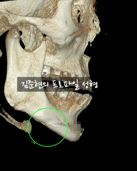턱끝전진술로 생긴 이차각은 어떻게 되나요?! 관련 이미지 4