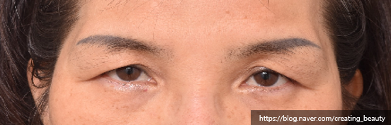 눈썹하거상술(Subbrow lift, Sub-browpexy)이 필요한 경우를 성형외과 전문의가 설명해 드립니다. 관련 이미지 2