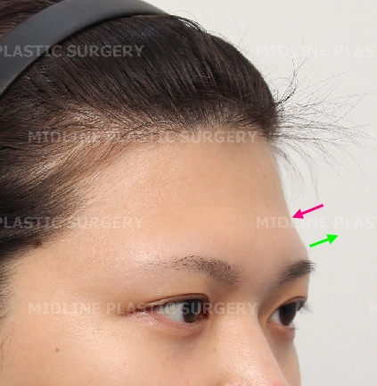 Forehead Lift for a Forehead with Prominent Brow Bones?? image 8