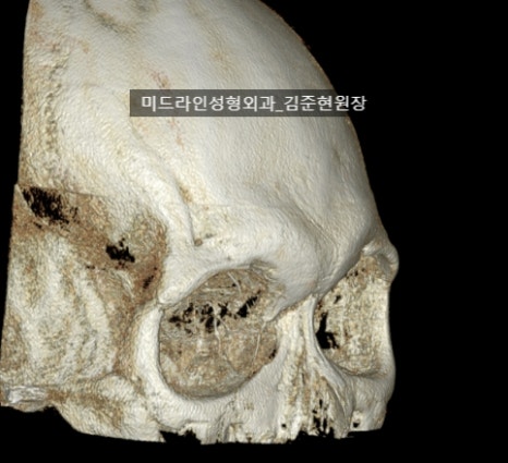 눈썹뼈 절삭에 관하여 (안와상융기) 관련 이미지 5