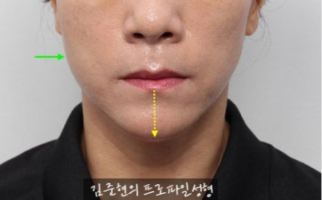 수술없이 간단하게 안면비대칭, 턱끝 비대칭(미드라인 맞추기) 해결하기!! 관련 이미지 6