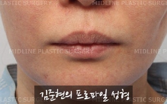 입술에 볼륨을 주는 방법은? 입술 지방이식에 관하여 관련 이미지 10