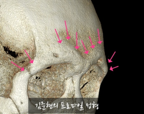 Let’s Learn About the Effects of Brow Bone Reduction Surgery. (Brow Bone? Eye Hole Bone? Here’s a Terminology Guide.) image 9