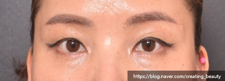 눈썹하거상술(Subbrow lift, Sub-browpexy)이 필요한 경우를 성형외과 전문의가 설명해 드립니다. 관련 이미지 7