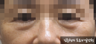성형외과 전문의가 눈밑수술 케이스의 진단방법 및 나이들면 하는 수술이다라는 오해에 대해 설명해드립니다. 관련 이미지 13