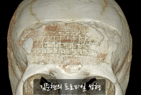 I Removed Two Forehead Implants. A Board-Certified Plastic Surgeon Explains Why I Do Not Recommend Forehead Implants. image 15
