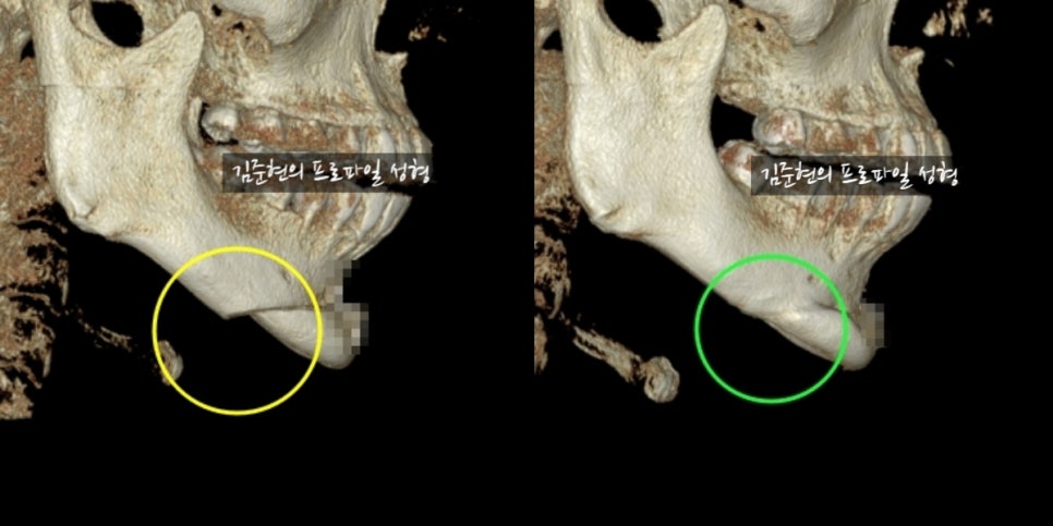 턱 끝 전진 후 2차각 어떡하죠? ㅠㅠ턱 끝 윤곽 수술 직후 보이는 이차각의 운명에 대하여 설명드립니다. 관련 이미지 3