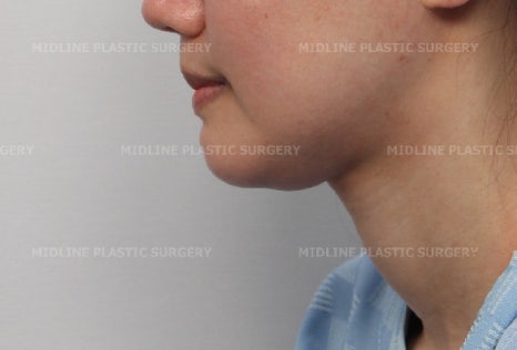Fixing a Sagging Double Chin After Contouring Surgery! Let’s Learn About Mid-Up Lifting 2040. image 13