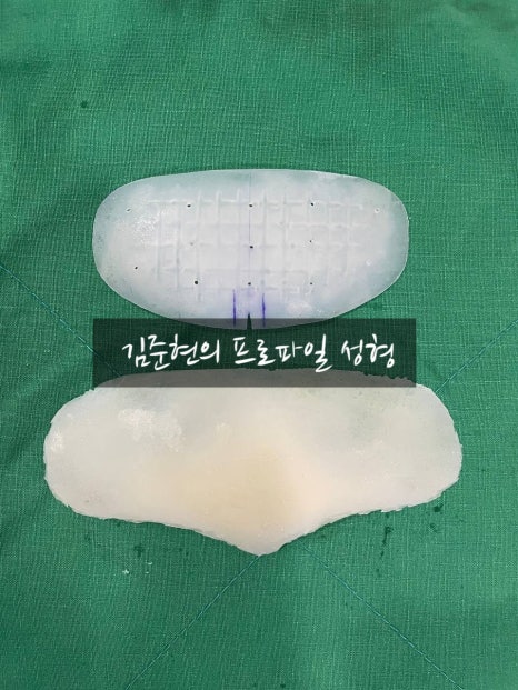 I Removed Two Forehead Implants. A Board-Certified Plastic Surgeon Explains Why I Do Not Recommend Forehead Implants. image 11