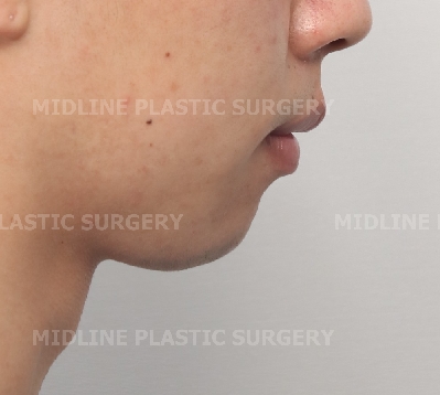 On the Effects of Advancement Genioplasty, Explained by a Board-Certified Plastic Surgeon. (feat. Rhinoplasty, Double Chin, Jawline Liposuction) image 5