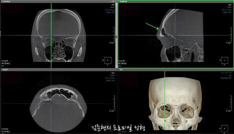 눈썹뼈절삭, 어떨 때 어떻게 하는 수술일까요? 꼭 이마거상과 함께 해야만 하는 수술인가요? 미드라인성형외과에서 하는 눈썹뼈절삭 수술을 설명드립니다. (3D CT 있음) 관련 이미지 26
