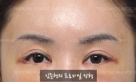 The outer corners of my eyes are open and my eyes stingㅠㅠI had lateral canthoplasty revision and eye corner restoration.(feat. Endoscopic forehead lift) image 5