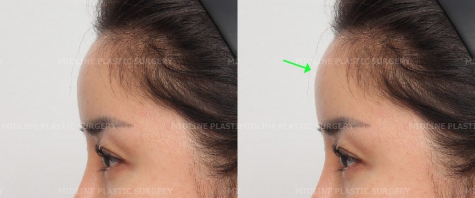 I want to remove my forehead implant because it makes my forehead look too voluminous, and I also want a forehead lift at the same time. (Feat. under-eye fat repositioning + fat grafting) image 1