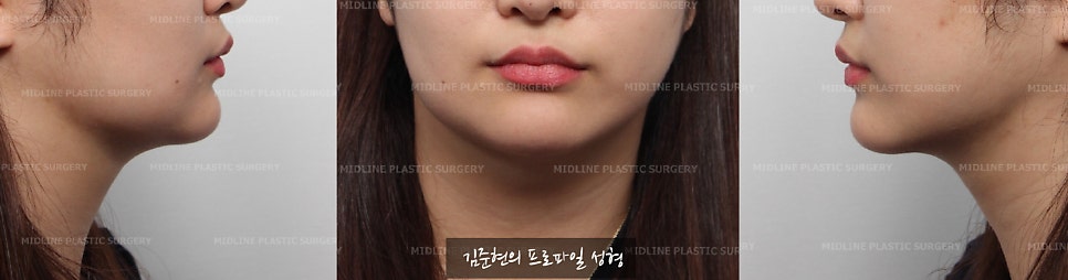 이중턱이 고민이에요ㅠㅠ숨은 턱선을 찾아주는 이중턱, 턱라인 지방흡입! 미드업 2040에 관하여 설명드립니다. 관련 이미지 5