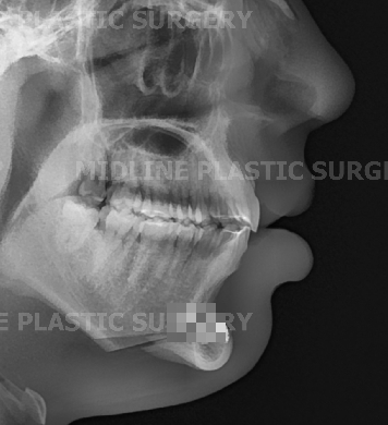 A Plastic Surgeon Explains the Changes in the Front and Side Views After Reduction Genioplasty and Advancement Genioplasty. (Feat. Rhinoplasty) image 14