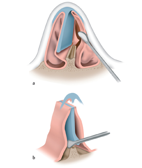 The Plastic Surgery Specialist Explains Septoplasty, One of the Methods for Functional Nose Surgery for Rhinitis. (feat. Swing-door Technique) image 6