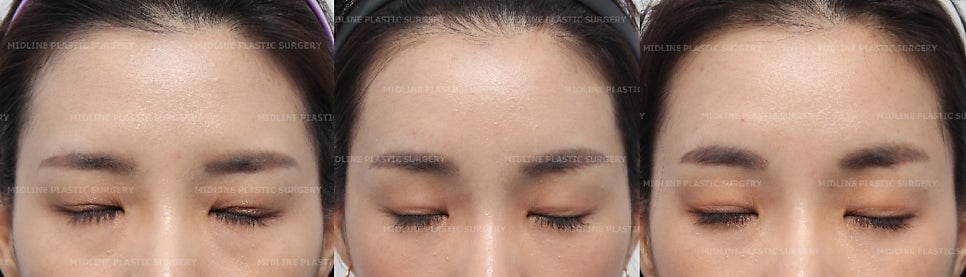 이마거상이 필요한 전형적인 케이스를 소개합니다! 더 일찍 할 껄ㅠㅠ하지 마시고 지금이 제일 빠를 때입니다. (Feat. 눈밑지방재배치와 눈밑지방이식) 관련 이미지 6