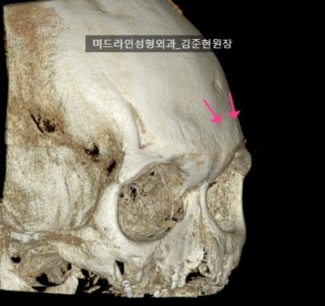 눈썹뼈 절삭에 관하여 (안와상융기) 관련 이미지 19