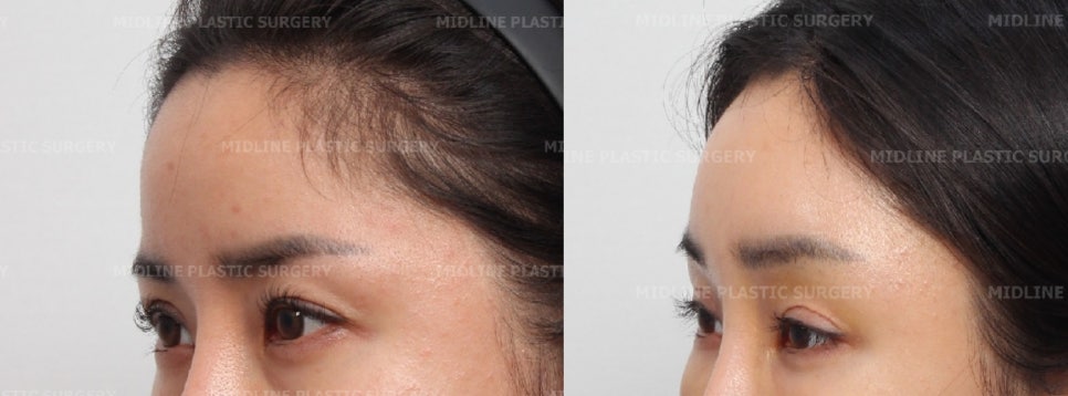 I want to remove my forehead implant because it makes my forehead look too voluminous, and I also want a forehead lift at the same time. (Feat. under-eye fat repositioning + fat grafting) image 6