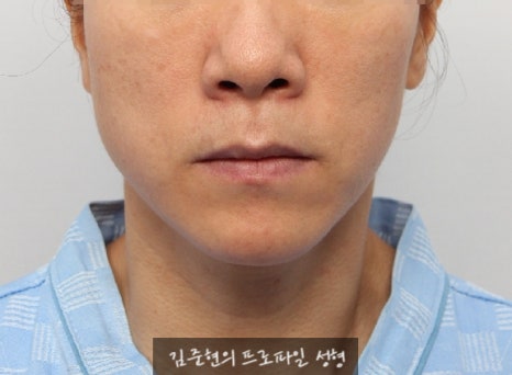 수술없이 간단하게 안면비대칭, 턱끝 비대칭(미드라인 맞추기) 해결하기!! 관련 이미지 3
