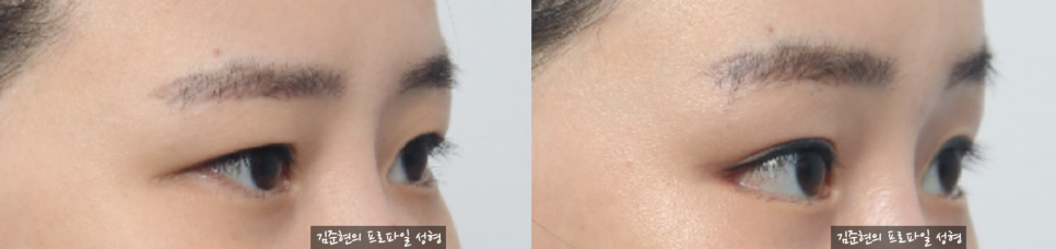 쌍꺼풀이 있는데 라인을 높이고  싶어요. 눈재수술을 하지 않고 라인 높이는 방법에 관하여 성형외과 전문의가 설명드립니다. (Feat. 내시경 이마거상, 뒤트임) 관련 이미지 4