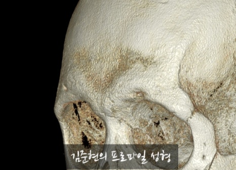 Let’s Learn About the Effects of Brow Bone Reduction Surgery. (Brow Bone? Eye Hole Bone? Here’s a Terminology Guide.) image 13