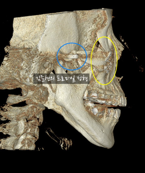 퀵광대 부작용으로 인한 광대 비대칭이 생겼어요. 어떡하죠? 성형외과 전문의가 설명드립니다. 관련 이미지 7