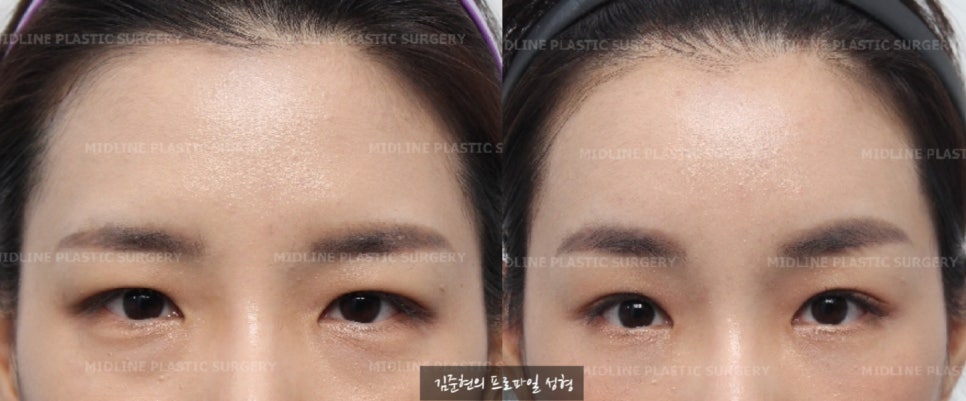 이마거상이 필요한 전형적인 케이스를 소개합니다! 더 일찍 할 껄ㅠㅠ하지 마시고 지금이 제일 빠를 때입니다. (Feat. 눈밑지방재배치와 눈밑지방이식) 관련 이미지 3