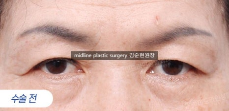 Forehead lift for people in their 20s and 30s: correcting eyelid sagging and even eye asymmetry! image 6